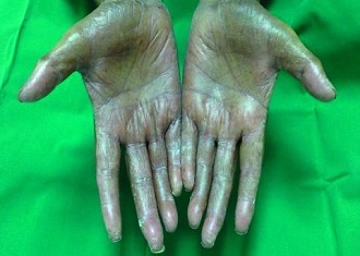 Grade 3 hand–foot syndrome with shedding of the skin of both palms (Oncologist/Dr. Mahmoud S. Al-Ahwal)